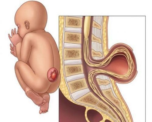 Rehabilitation after meningeal hernia