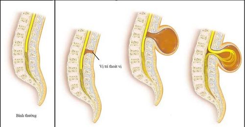 Surgery for meningeal hernia in the dorsal/sacral region