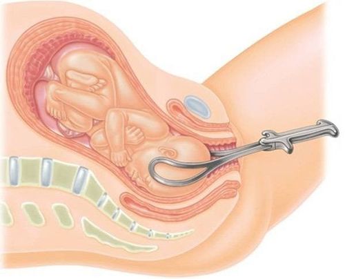 Hỗ trợ sinh bằng kỹ thuật đặt Forceps: Những điều cần biết