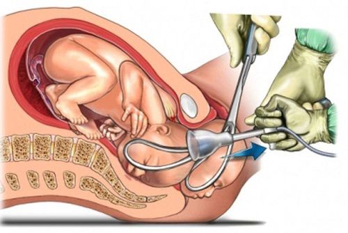 
Sinh giúp bằng Forceps là thủ thuật hỗ trợ giúp sức cho sản phụ sinh trong giai đoạn sổ thai.
