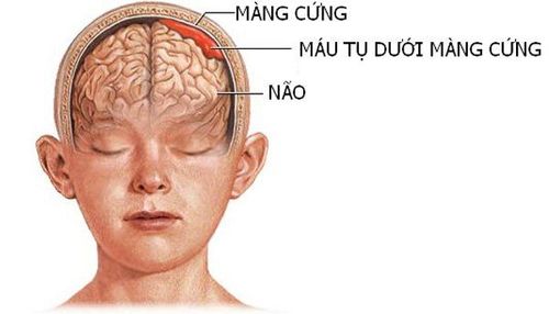 Máu tụ dưới màng cứng: Triệu chứng, chẩn đoán và điều trị