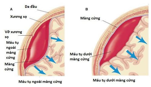 Huyết khối tĩnh mạch màng cứng là gì?