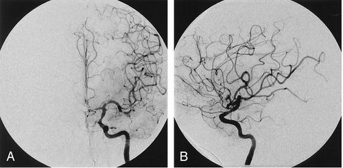 Application of digital background deletion angiography (DSA) in the field of neurology