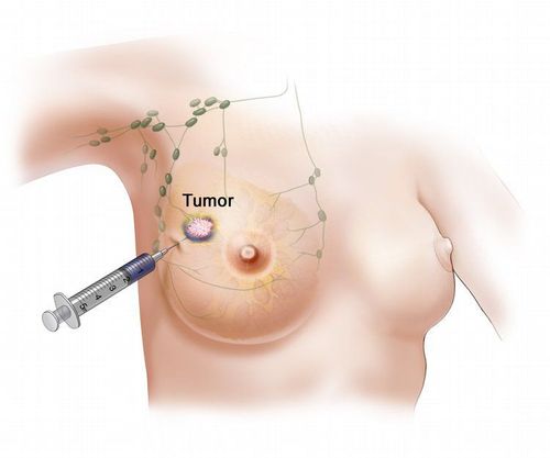 
Sinh thiết kim nhỏ là dùng một cây kim nhỏ đâm vào vú và rút thành phần chứa bên trong khối u ra
