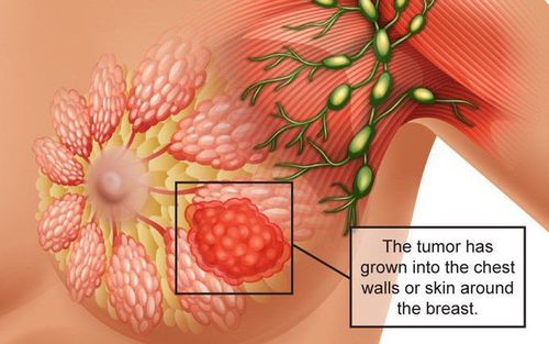 
U diệp thể tuyến vú là một dạng bệnh lý lành tính của tuyến vú
