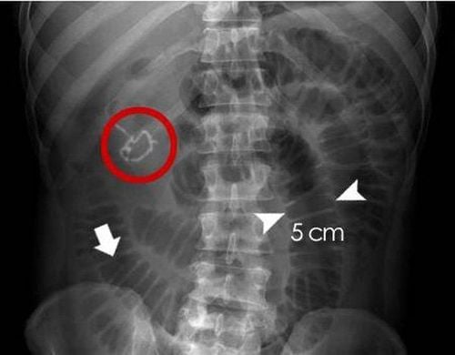 Causes of small bowel obstruction