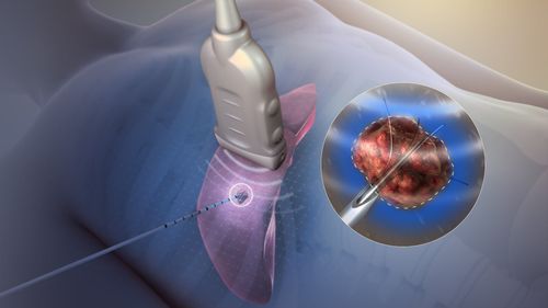 Application of radiofrequency ablation (RFA) in the treatment of common diseases