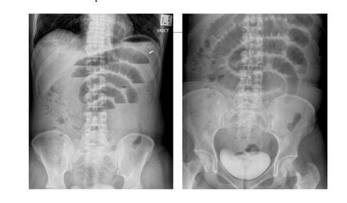 X-ray images in the diagnosis of intestinal obstruction