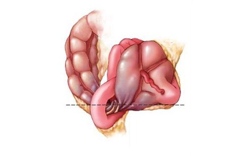 
Xoắn đại tràng khó có thể chẩn đoán lâm sàng
