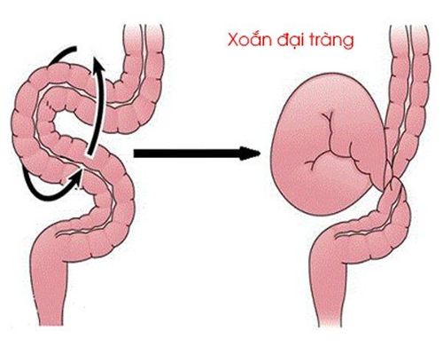 Xoắn đại tràng Sigma ở trẻ em