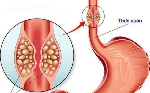 Ung thư thực quản: Nguyên nhân, triệu chứng, tiên lượng bệnh và cách điều trị