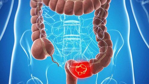 What you need to know about colorectal cancer