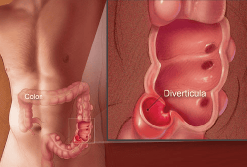 The role of surgery in the diagnosis of diverticulitis