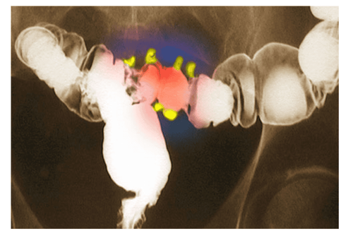 What should be done to treat diverticulitis?