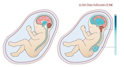 Causes of neural tube defects in children