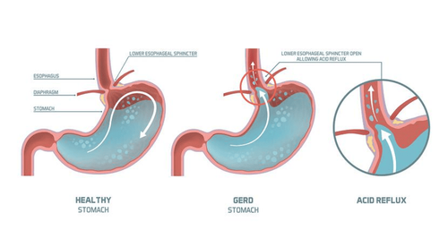 Gastroesophageal reflux disease - esophagus and gastroesophageal reflux disease