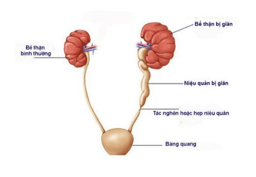 
Sỏi niệu quản là nguyên nhân gây tức nghẽn đường tiết niệu
