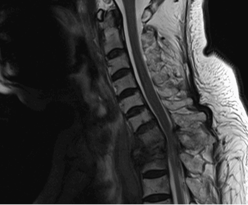 
                    Cervical vertebrae destruction and spinal cord compression by myeloma
                