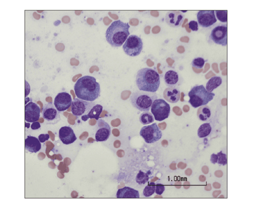 
Myeloma cells as seen in a bone marrow aspirate
