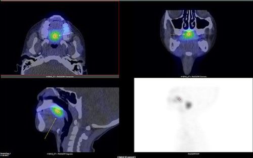 
Hình ảnh tuyến giáp lạc chỗ vùng gốc lưỡi phát hiện trên SPECT/CT
