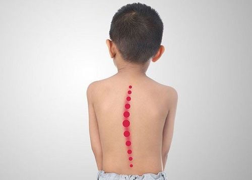 Scoliosis correction surgery in children