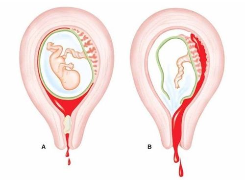 
Vỡ tử cung có thể xảy ra khi thai bám vào vết mổ tử cung cũ
