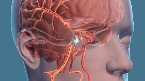 Subjects prone to cerebral aneurysms