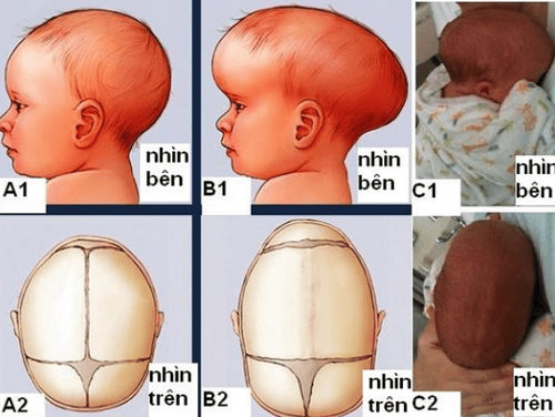 
Dính khớp sọ gây biến dạng hộp sọ ở người bệnh.
