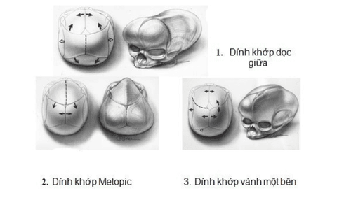 
Hình ảnh một số loại dính khớp sọ
