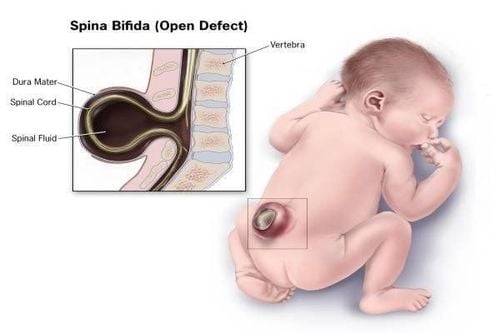 Diagnosis and treatment of meningeal hernia in neonates