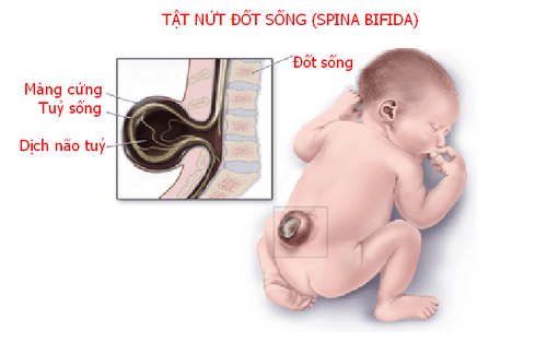 
Tật nứt đốt sống xảy ra khi có bất thường trong sự phát triển của tủy sống ở trẻ sơ sinh
