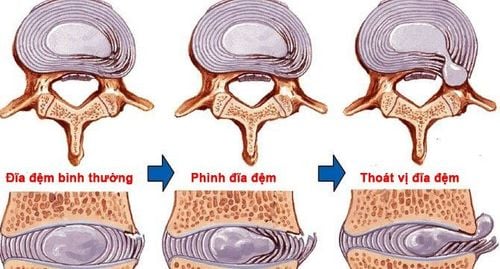 
Phồng đĩa đệm là một trong nhiều nguyên nhân dẫn tới thoát vị đĩa đệm
