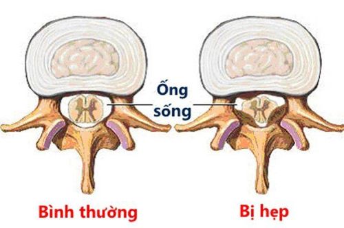 Spinal stenosis: When is surgery needed?