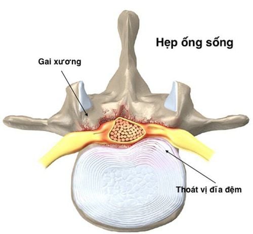 
Sự hình thành gai xương từ thân đốt sống có thể là nguyên nhân gây hẹp ống sống
