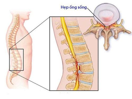 
Hẹp ống sống thắt lưng là một bệnh lý rất hay gặp, gây ảnh hưởng đến chất lượng cuộc sống của người bệnh
