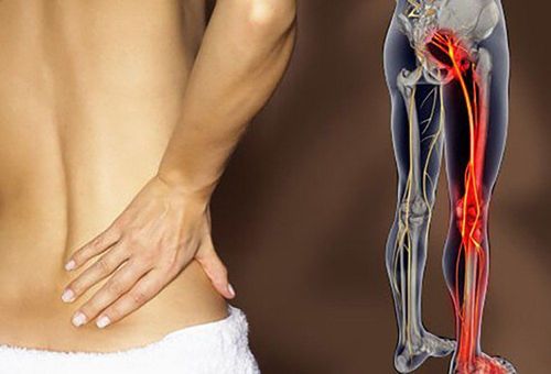 How is sciatica in young people different from old people?