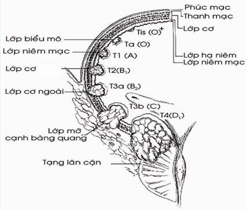 
Hình ảnh mô tả độ sâu xâm lấn thành bàng quang theo Jewett (năm 1946)
