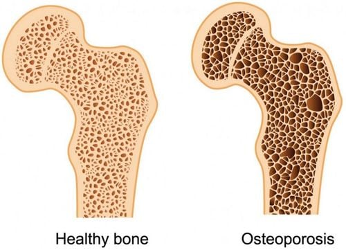 Osteoporosis and Steroid Drugs
