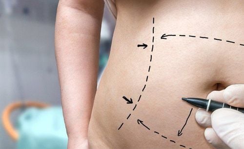 Abdominoplasty: What you need to know