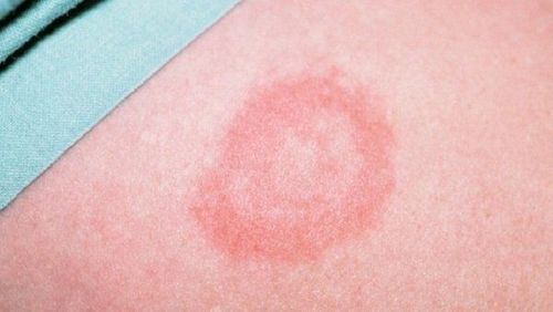 Lưu ý trong chẩn đoán và điều trị bệnh Lyme