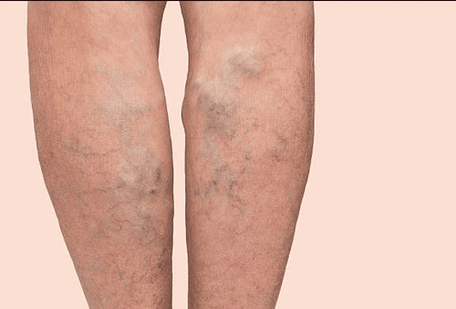 Laser treatment of varicose veins of the lower extremities