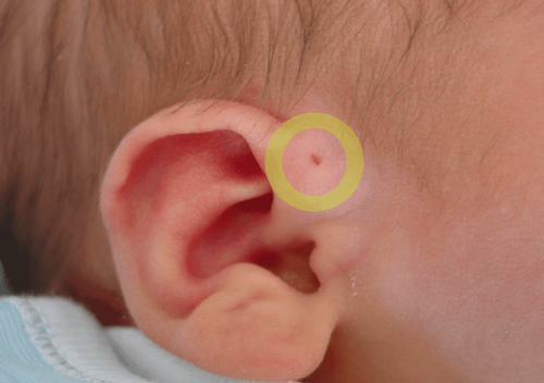 Vành tai bé 8 tháng có 1 lỗ nhỏ khi nào có thể phẫu thuật được?