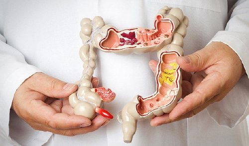 What are stomach polyps? Causes and treatments