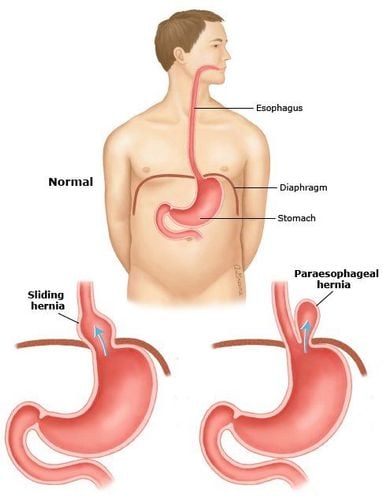 
Triệu chứng trong thoát vị cơ hoành ở người lớn rất đa dạng
