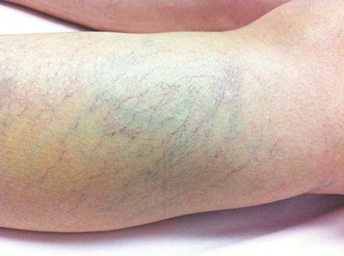 Some notes on lower extremity venous insufficiency