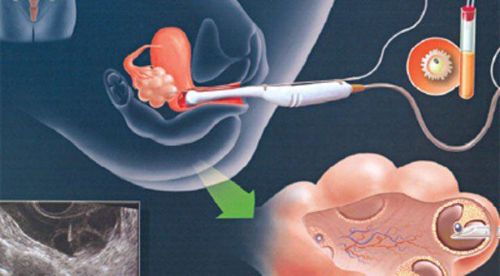 
Một loại thuốc hỗ trợ sinh sản kích thích buồng trứng phát triển nhiều trứng trưởng thành để thụ tinh
