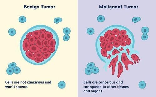 Common benign tumors