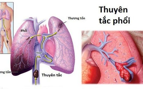 Early signs of pulmonary embolism