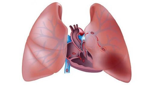 Complications of pulmonary embolism