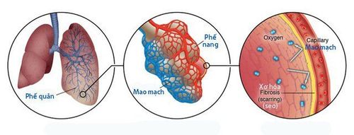 3. Đối tượng có nguy cơ cao mắc xơ phổi